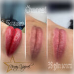 Eski kontür hatlarının doğal hale getirilmesi Karşıyaka dudak kontürü düzeltme öncesi sonrası